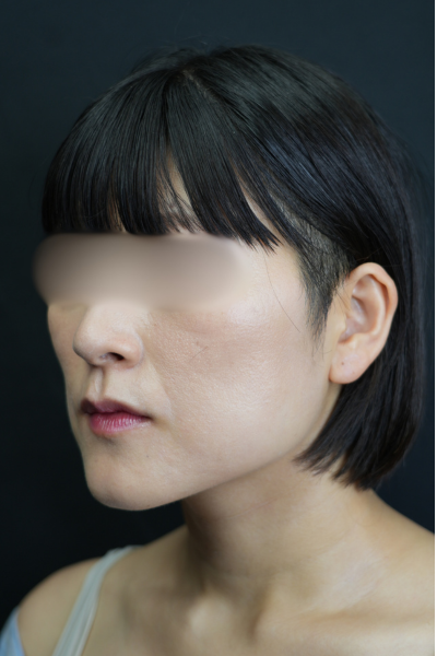 手術前の状態 その1