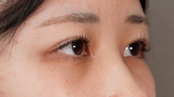 手術前の状態 その1