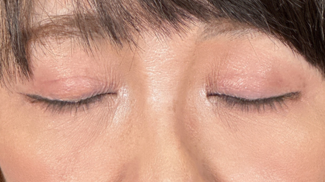 手术前的状态 其一