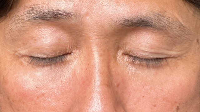 手术前的状态 其一