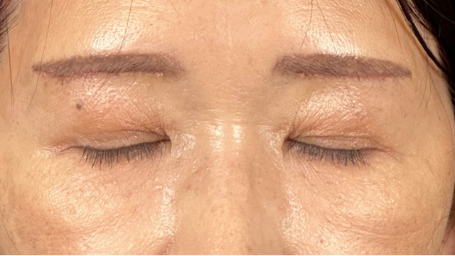 手術前の状態 その1