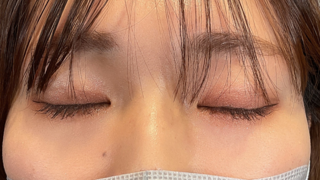 手術前の状態 その1