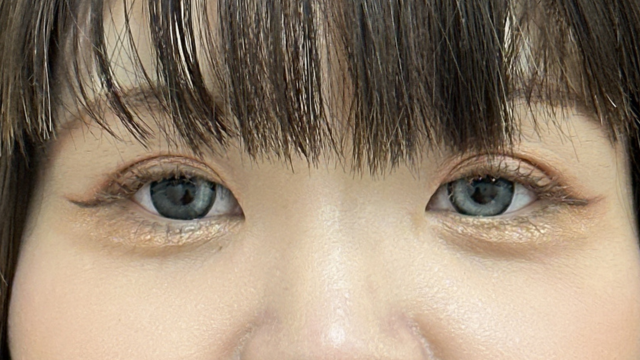 手術前の状態 その1