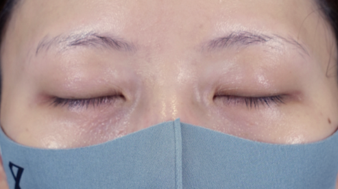 手术前的状态 其一