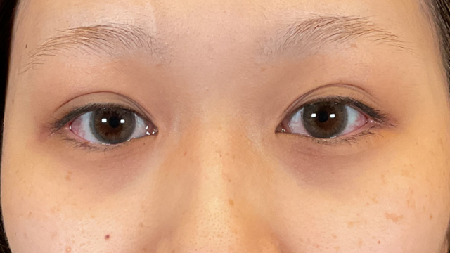 手术前的状态 其一