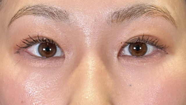 手術前の状態 その1