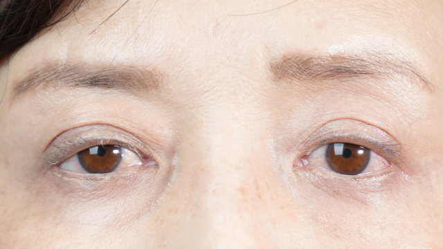 手術前の状態 その1