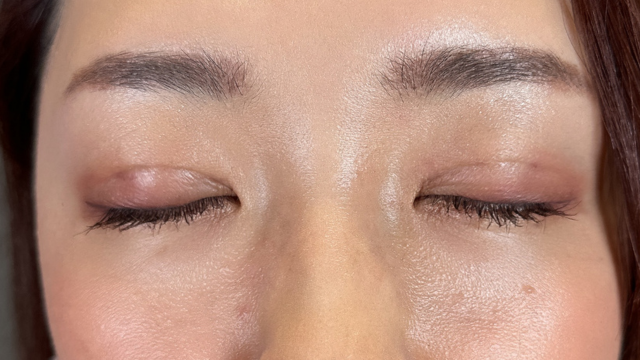 手术前的状态 其一