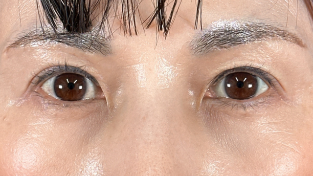 手術前の状態 その1