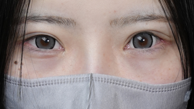 手術前の状態 その1