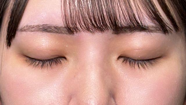 手術前の状態 その1