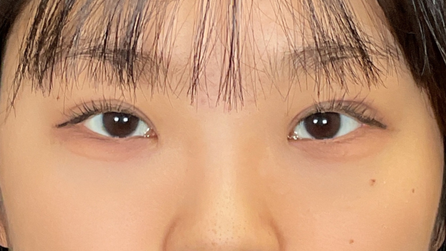 手術前の状態 その1