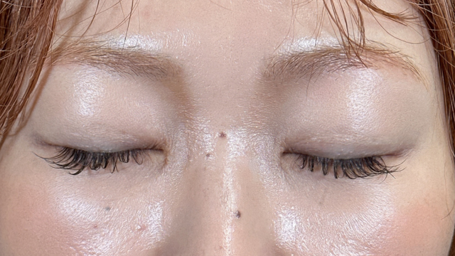 手术前的状态 其一