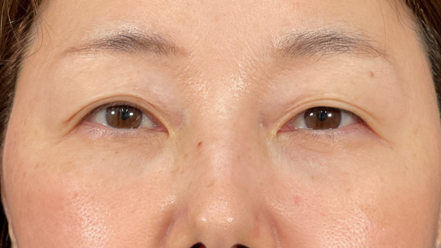 手术前的状态 其一