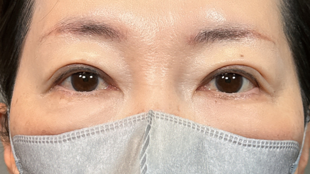 手術前の状態 その1