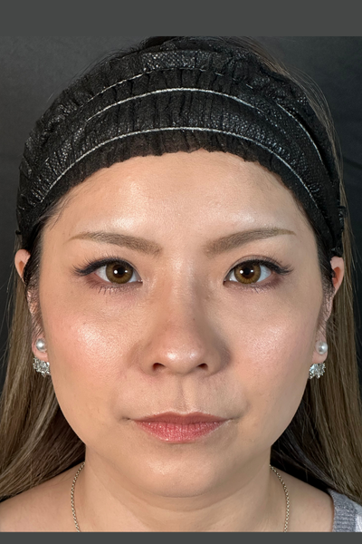 手术前的状态 其一