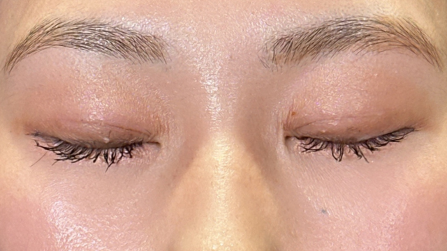 手術前の状態 その1