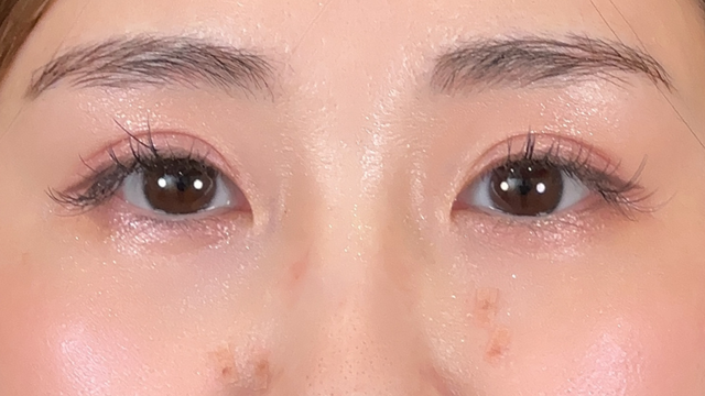 手術前の状態 その1