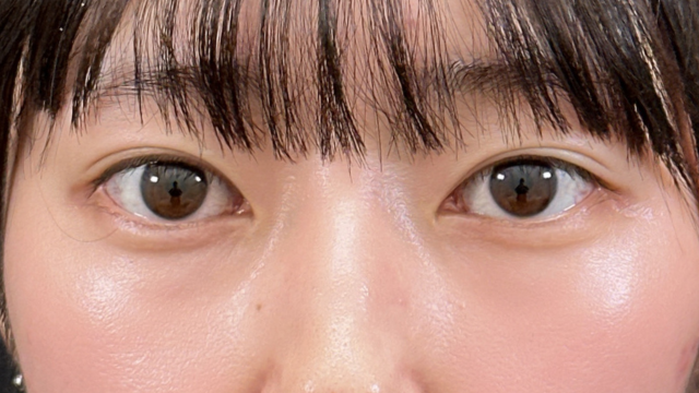 手術前の状態 その1