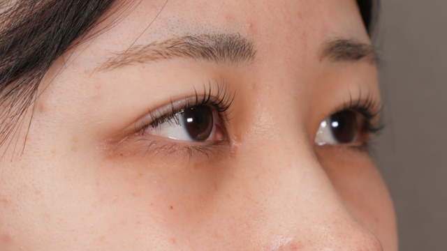 手術前の状態 その1