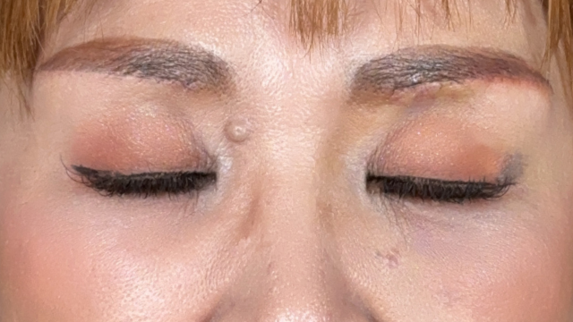 Postoperative Condition Part 1