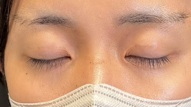 手术前的状态 其一