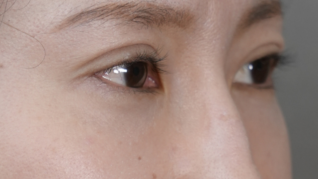 手術前の状態 その1