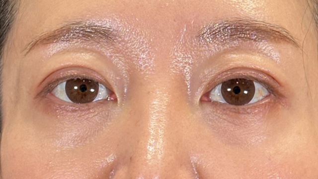 手術前の状態 その1