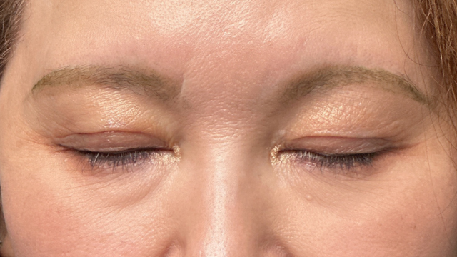 手术前的状态 其一