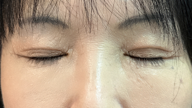 手術前の状態 その1