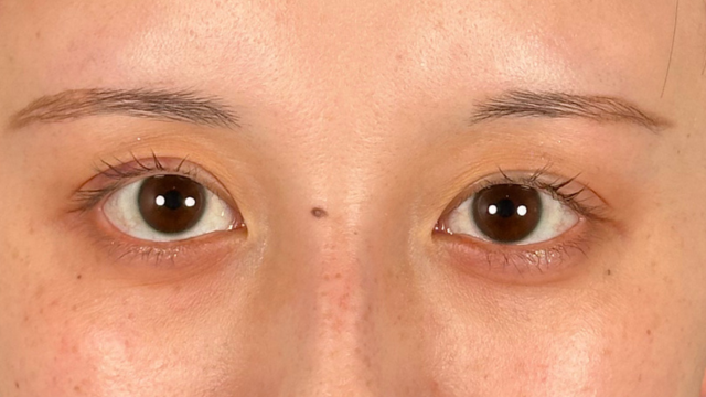 手术前的状态 其一