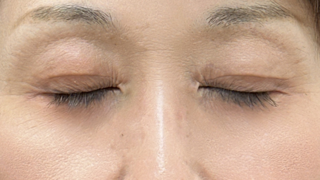 手术前的状态 其一