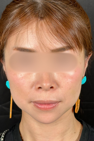 手术前的状态 其一