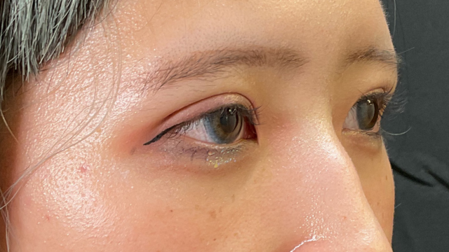 手術前の状態 その1