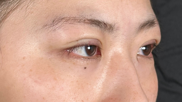 手术前的状态 其一