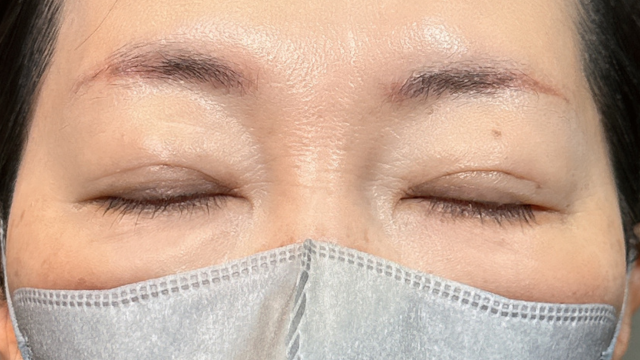 手術前の状態 その1