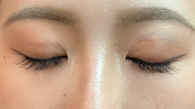 手術前の状態 その1