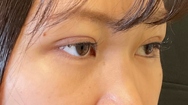 Postoperative Condition Part 1