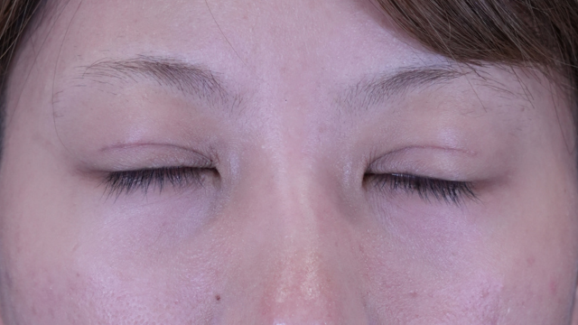 手術前の状態 その1