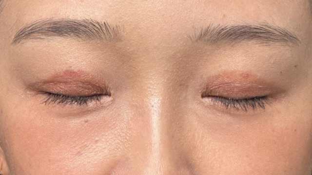 手术前的状态 其一