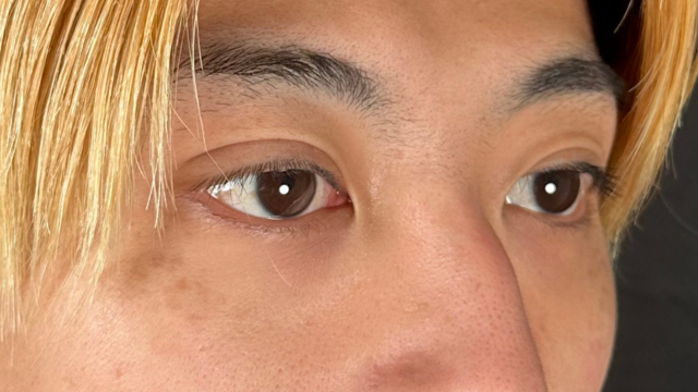 手术前的状态 其一