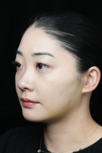 手术前的状态 其一