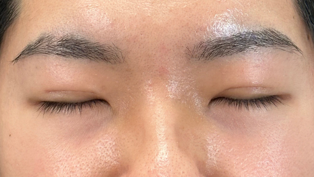 手術前の状態 その1