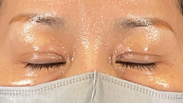 手術前の状態 その1