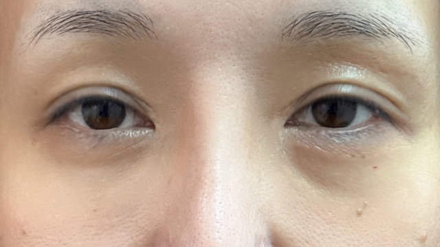 手術前の状態 その1