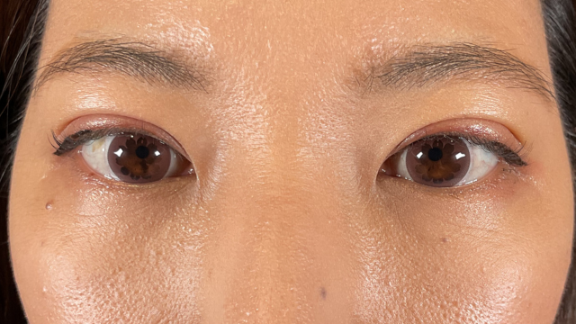 手術前の状態 その1