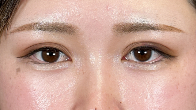 手術前の状態 その1