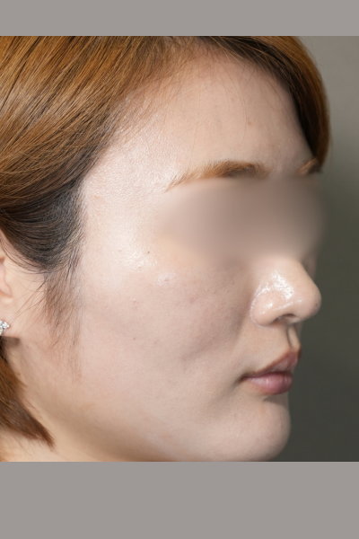 手術前の状態 その1