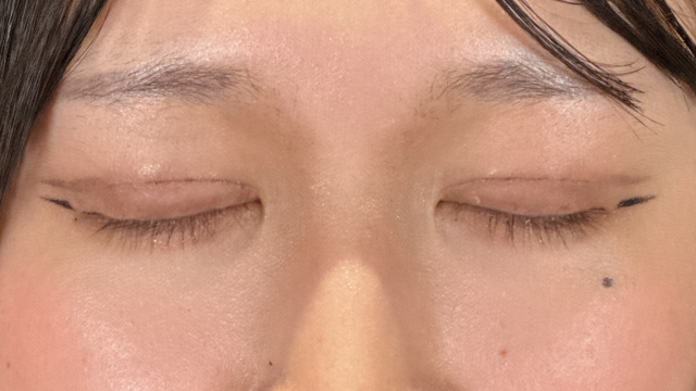 手术前的状态 其一