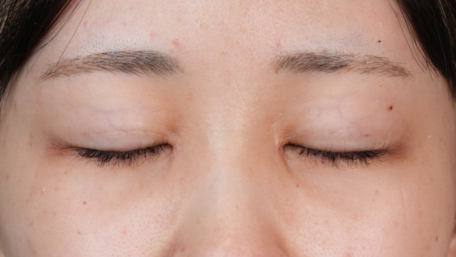 手術前の状態 その1